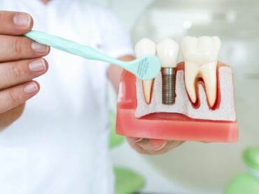 Implanty zębów a wpływ na codzienne funkcjonowanie